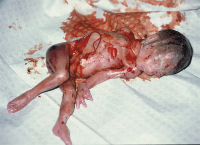 Убитый во время аборта ребенок
