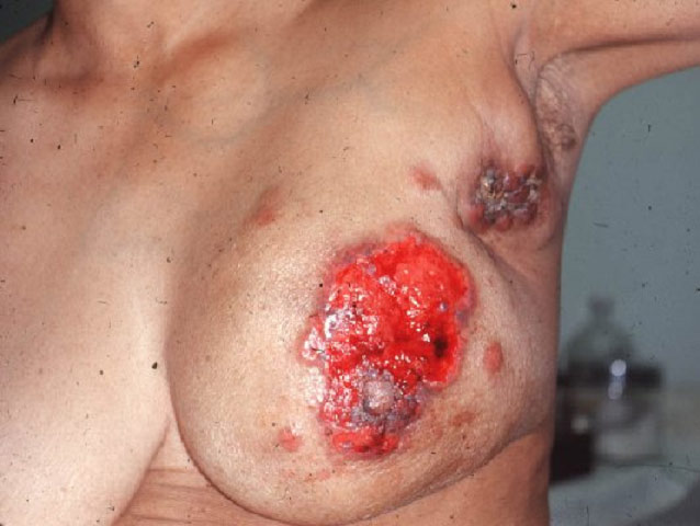 Рак груди (молочной железы): его связь с абортами и противозачаточными пилюлями