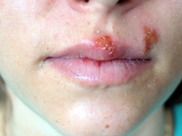 Типичное проявление герпесвирусной инфекции на лице