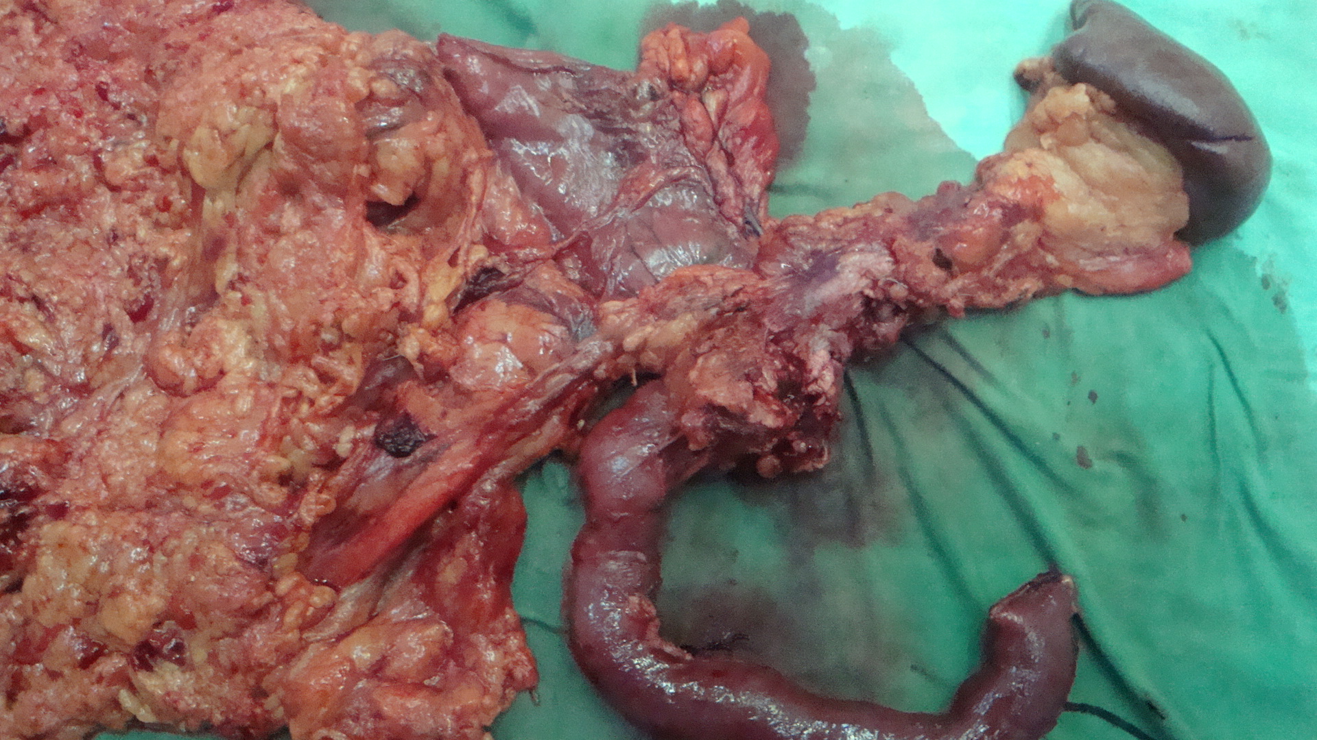 Рак прямой кишки. Удаленный кишечник с опухолью и брыжейкой с метастазами