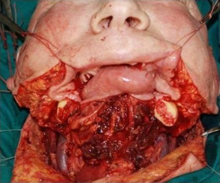 Запущенная форма рака челюсти и ротовой полости