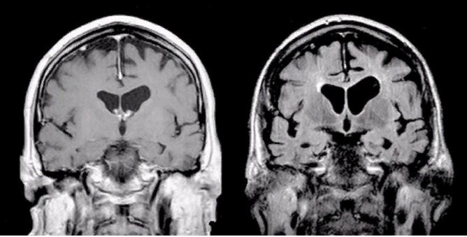 Рисунок 1. Сравнение двух МРТ-снимков одного и того же мужчины. Слева - мозг за 2 года до диагностики болезни Альцгеймера, справа - в период, когда ему было диагностировано это заболевание. Справа заметно истончение коры полушарий и расширение борозд (признаки атрофического процесса).