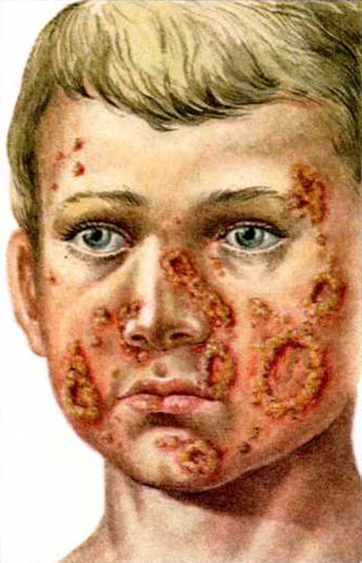 Лицо ребенка с йододермой: видны слившиеся пустулы, изъязвленные в центральной части и покрытые коркам