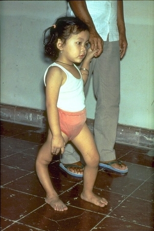 Ребенок с  гипотонусом мышц ног, обусловленный полиомиелитом