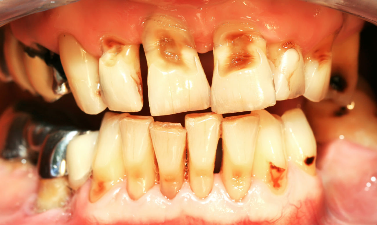 Болезни зубов на веганстве и сыроедении. Потеря зубов и эмали, эрозии. Изменение Ph слюны. Эрозия эмали зубов. Как соки деминерализуют зубы?