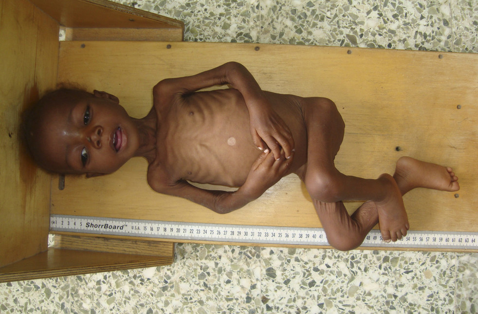 Голод и дистрофия сомалийских детей