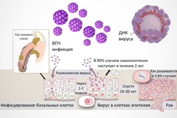 Вирус папилломы человека и рак полового члена